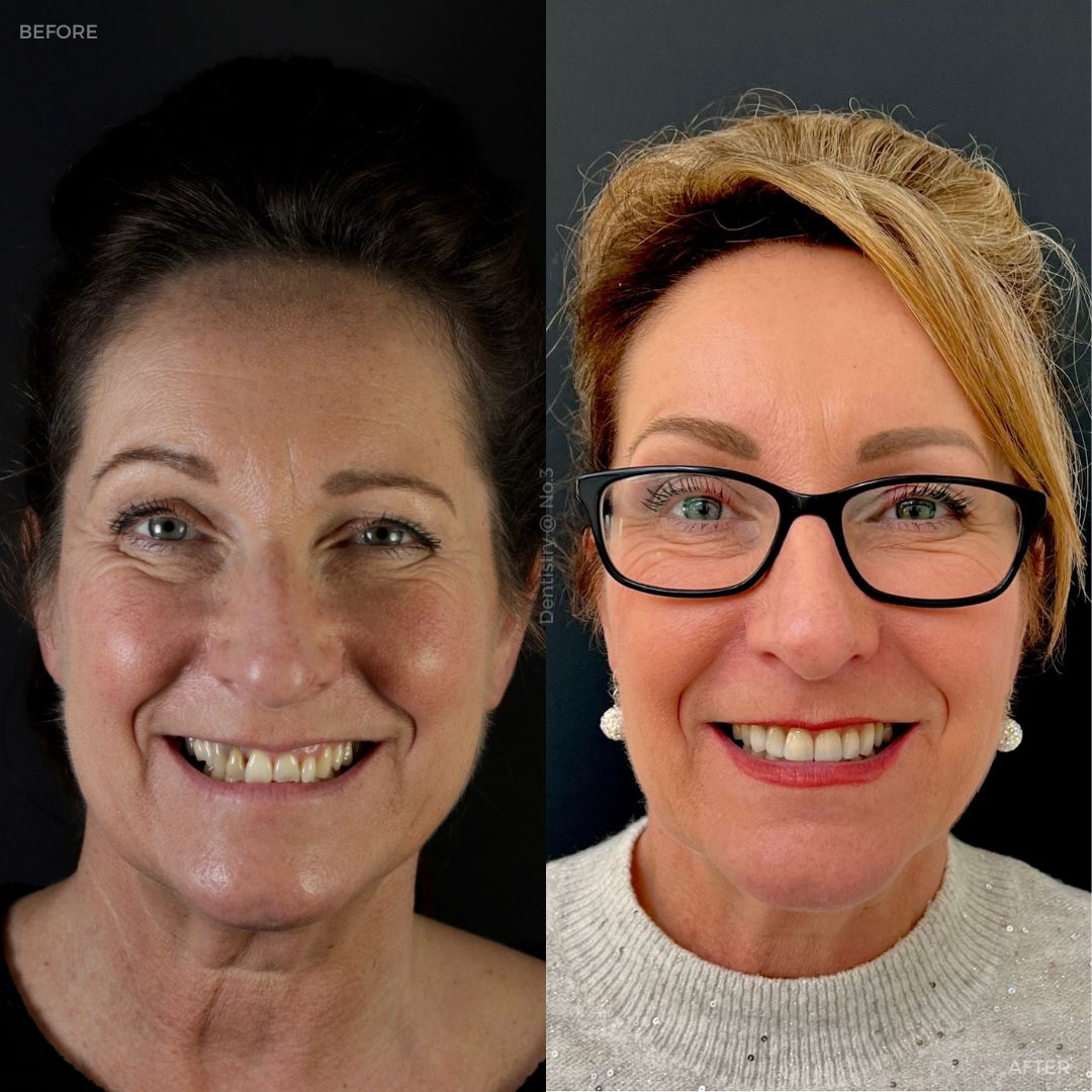 Dentistry @ No.3, 3 Comely Park | Dentistry @ No.3 & Century House Before and after treatment