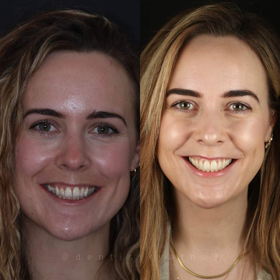 Invisalign & Composite Bonding