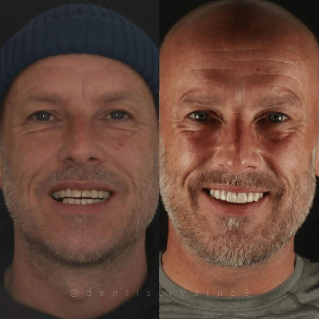Invisalign, Whitening & Veneers