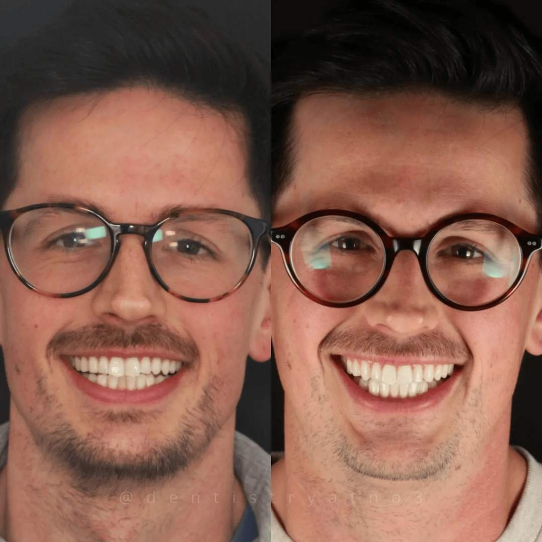 Invisalign & Composite Bonding