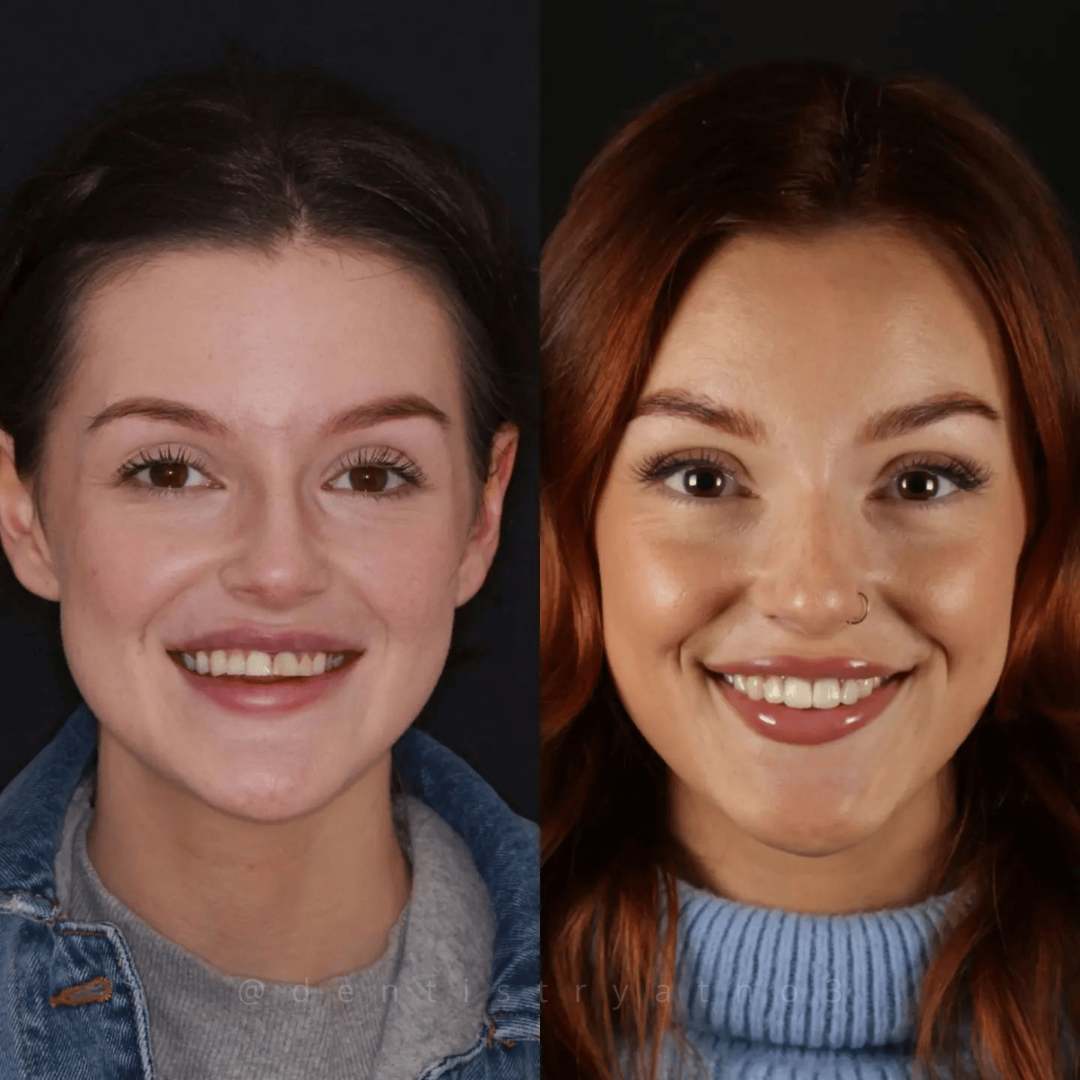 Porcelain Veneers