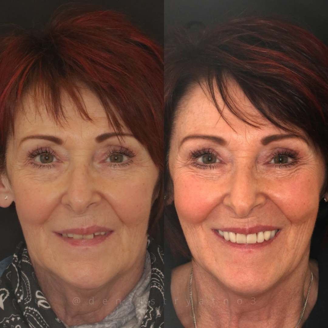 Partial Denture & Crowns