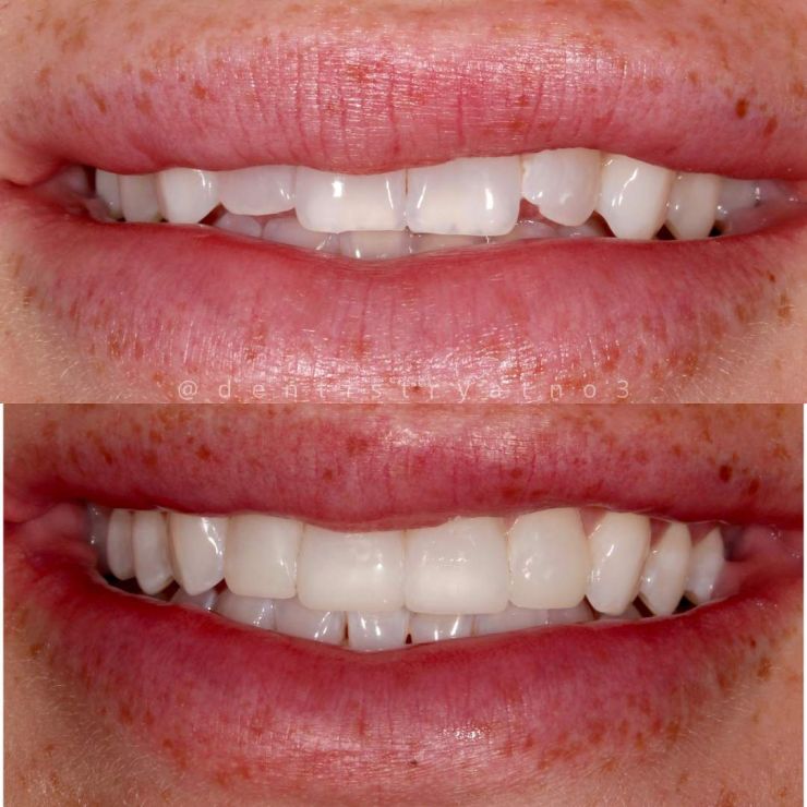 Smile Gallery | Dentistry @ No.3 & Century House Transforming Smiles
