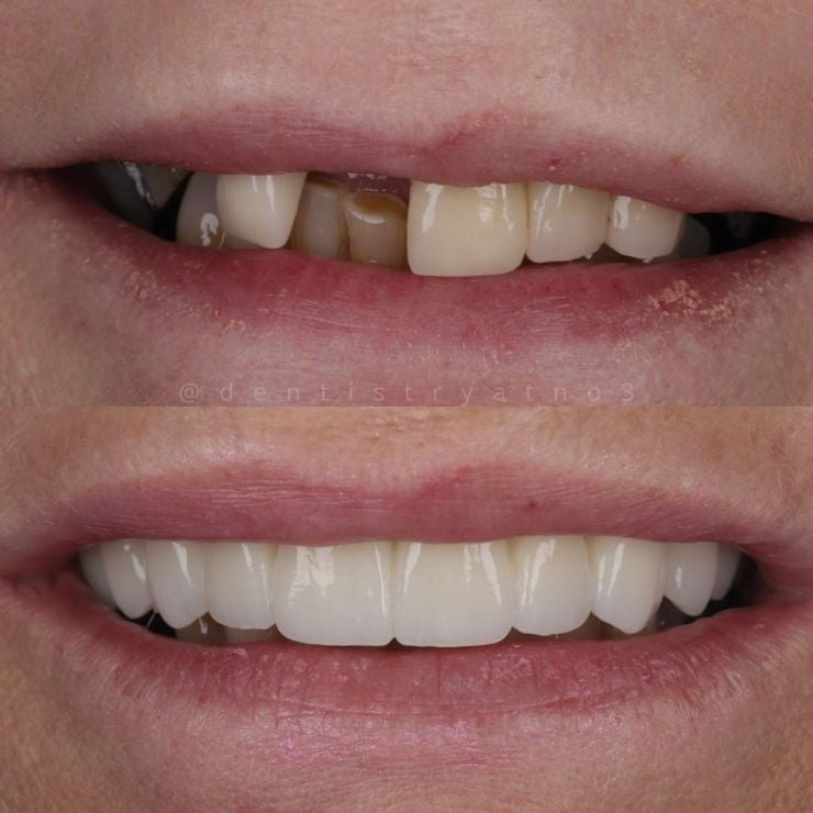 Smile Gallery | Dentistry @ No.3 & Century House Transforming Smiles