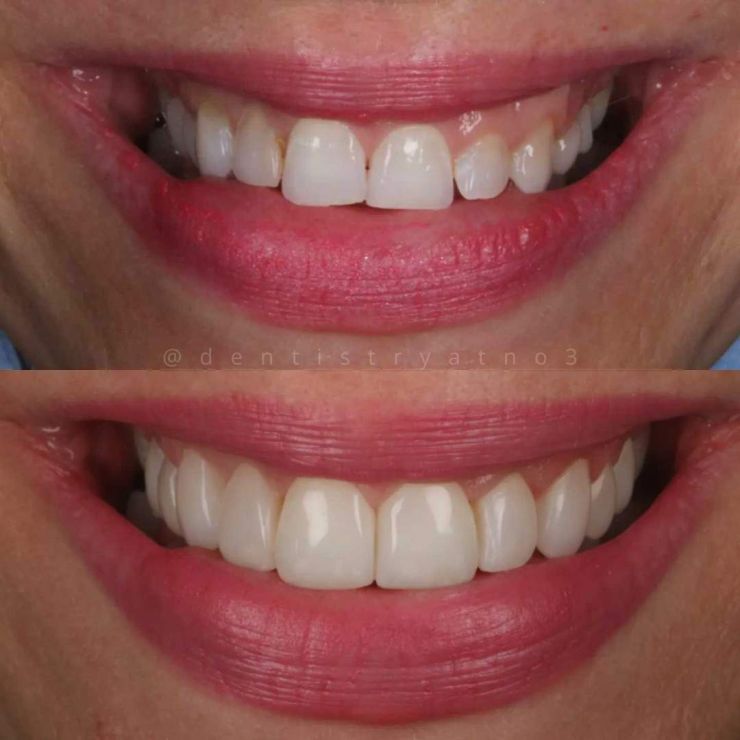 Smile Gallery | Dentistry @ No.3 & Century House Transforming Smiles