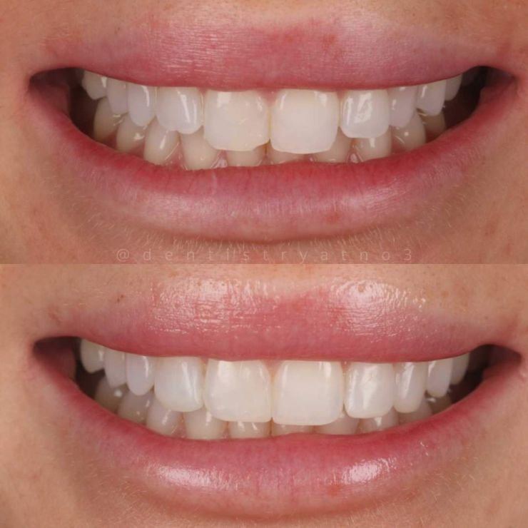Smile Gallery | Dentistry @ No.3 & Century House Transforming Smiles