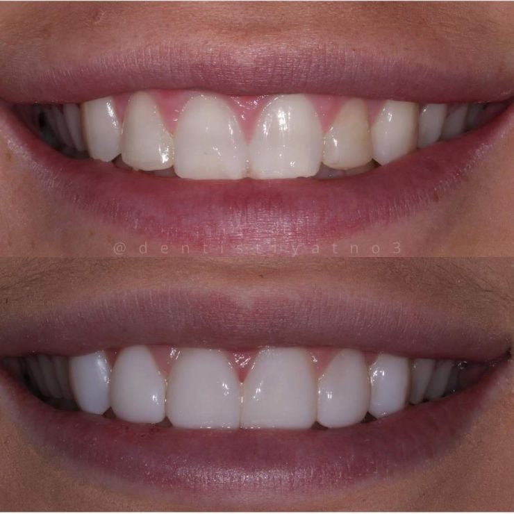 Smile Gallery | Dentistry @ No.3 & Century House Transforming Smiles