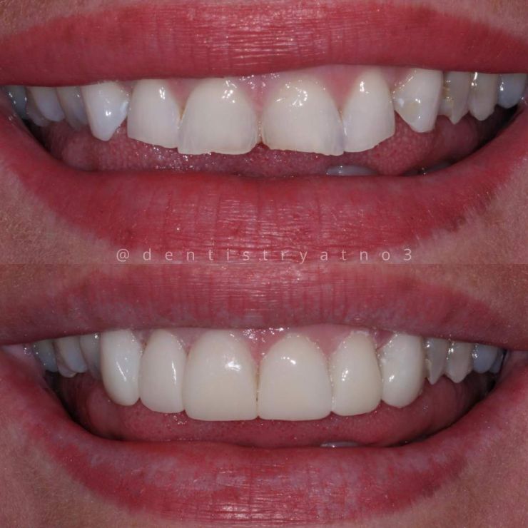 Smile Gallery | Dentistry @ No.3 & Century House Transforming Smiles