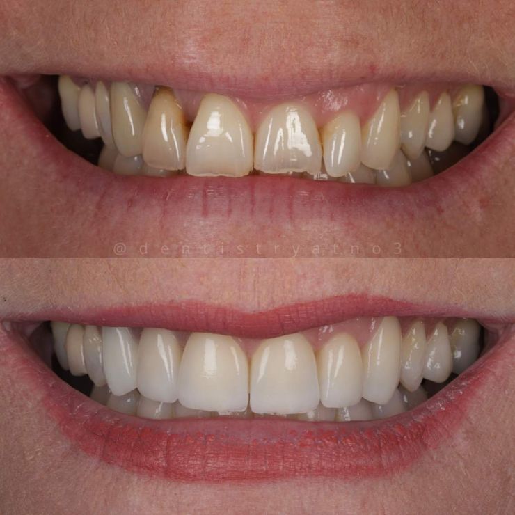 Smile Gallery | Dentistry @ No.3 & Century House Transforming Smiles