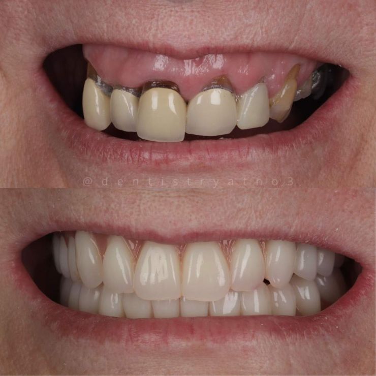 Smile Gallery | Dentistry @ No.3 & Century House Transforming Smiles