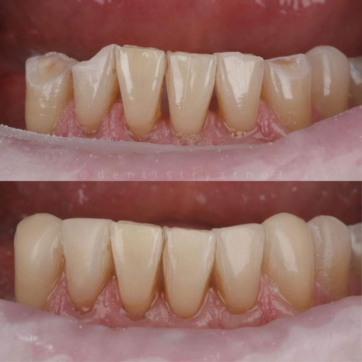 Smile Gallery | Dentistry @ No.3 & Century House Transforming Smiles